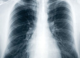 Tuberculosis - Old Disease, New Threat - Training Network